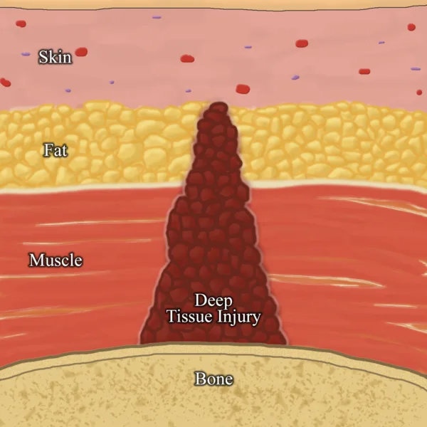 A cross-section illustration of skin, fat, muscle and bone with a dark red deep tissue injury forming as a cone at the bone-muscle interface and spreading upward